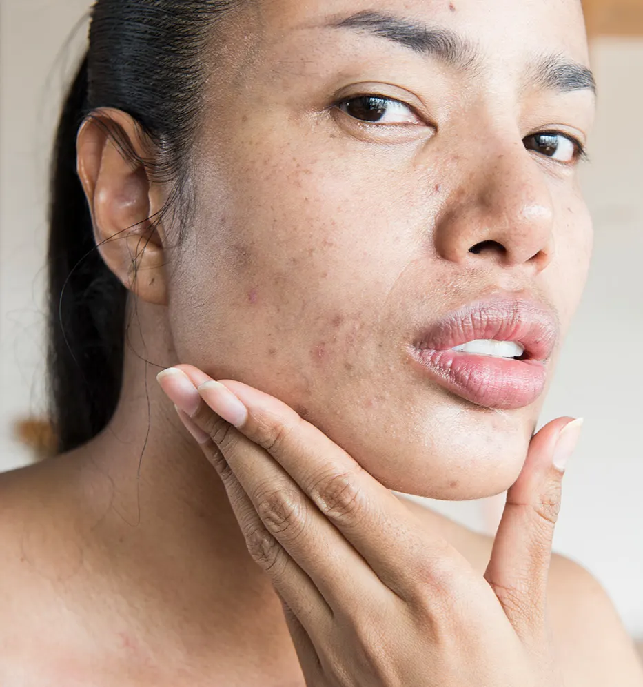 Truques Efetivos para Combater Acne e Manchas na Pele